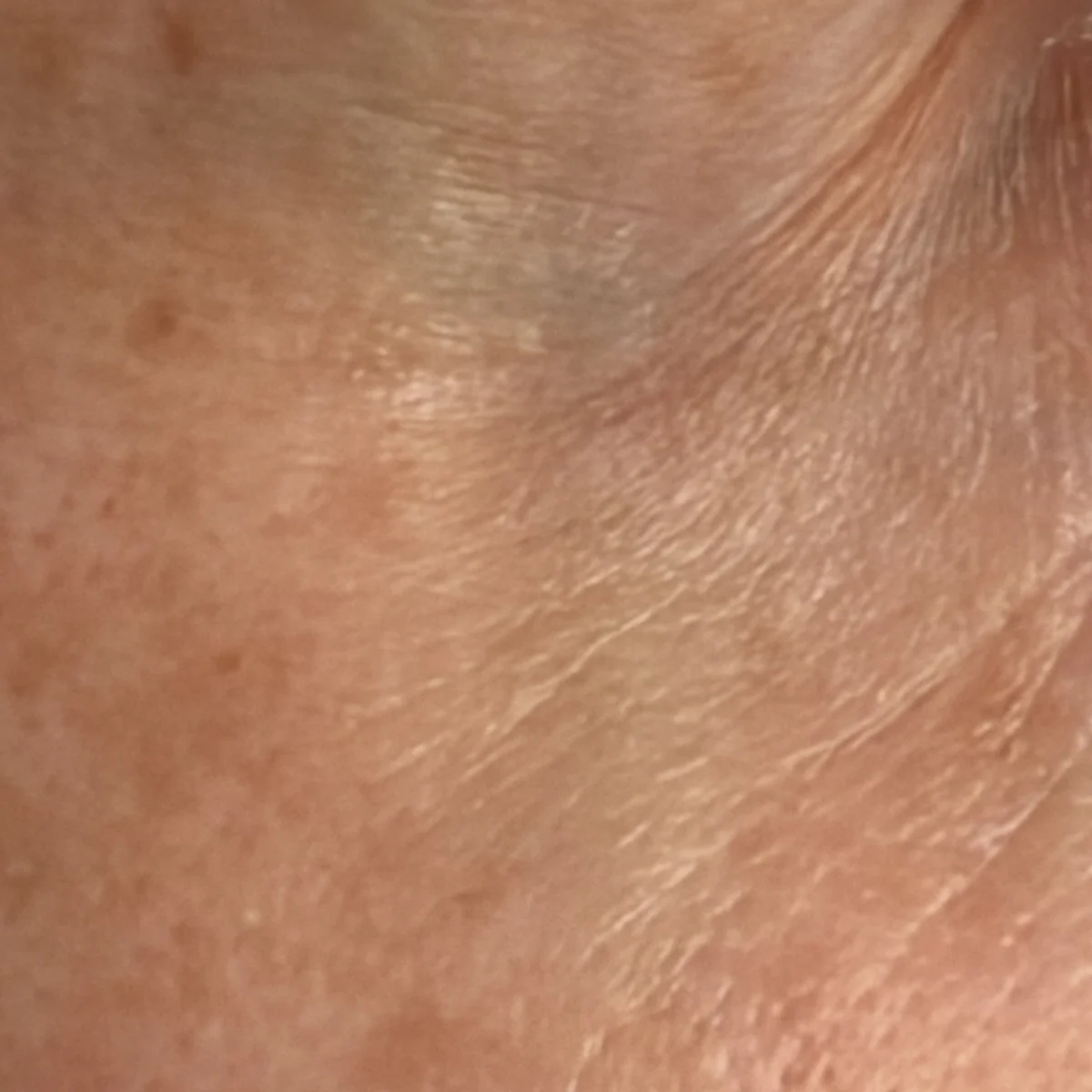 Eye area after using SEISUI