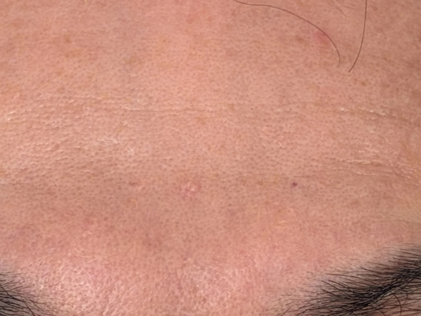 Forehead after using SEISUI
