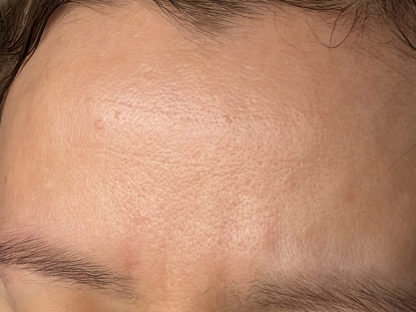 Forehead after using SEISUI
