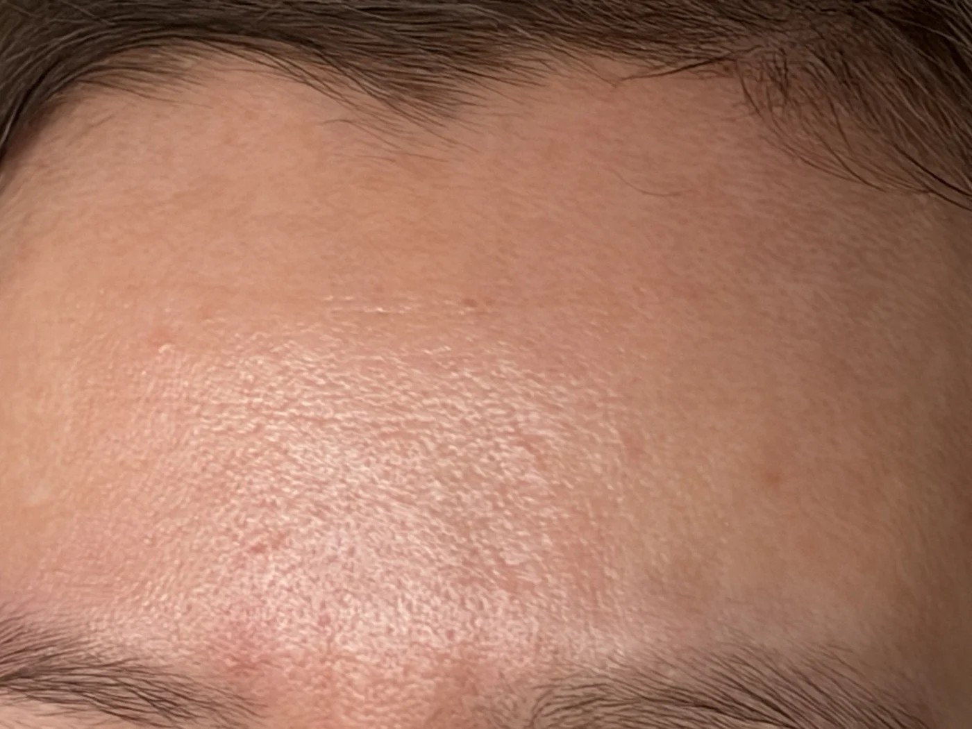 Forehead before using SEISUI